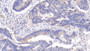 DAB staining on IHC-P; Sample: Human Colorectal cancer Tissue; Primary Ab: 20ug/ml Mouse Anti-Human Bcl2 Antibody Second Ab: 2ug/mL HRP-Linked Caprine Anti-Mouse IgG Polyclonal Antibody