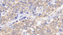 DAB staining on IHC-P; Sample: Human Lymphoma Tissue; Primary Ab: 20ug/ml Mouse Anti-Human Bcl2 Antibody; Second Ab: 2ug/mL HRP-Linked Caprine Anti-Mouse IgG Polyclonal Antibody