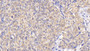 DAB staining on IHC-P; Sample: Human Ovarian cancer Tissue; Primary Ab: 20ug/ml Mouse Anti-Human Bcl2 Antibody; Second Ab: 2ug/mL HRP-Linked Caprine Anti-Mouse IgG Polyclonal Antibody