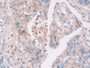 DAB staining on IHC-P; Sample: Human Lung cancer Tissue; Primary Ab: 20ug/ml Mouse Anti-Human GSN Antibody Second Ab: 2ug/mL HRP-Linked Caprine Anti-Mouse IgG Polyclonal Antibody