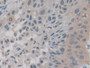 DAB staining on IHC-P; Sample: Human Lung cancer Tissue; Primary Ab: 30ug/ml Mouse Anti-Human VEGF121 Antibody Second Ab: 2ug/mL HRP-Linked Caprine Anti-Mouse IgG Polyclonal Antibody