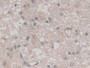 DAB staining on IHC-P; Sample: Human Glioma Tissue; Primary Ab: 30ug/ml Mouse Anti-Human VEGF121 Antibody; Second Ab: 2ug/mL HRP-Linked Caprine Anti-Mouse IgG Polyclonal Antibody