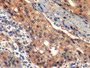 DAB staining on IHC-P; Sample: Human Lymphoma Tissue; Primary Ab: 10ug/ml Mouse Anti-Human HAVCR2 Antibody; Second Ab: 2ug/mL HRP-Linked Caprine Anti-Mouse IgG Polyclonal Antibody