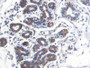 DAB staining on IHC-P; Samples: Human Breast cancer Tissue; Primary Ab: 20ug/ml Mouse Anti-Human S100A8 Antibody Second Ab: 2ug/mL HRP-Linked Caprine Anti-Mouse IgG Polyclonal Antibody