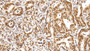DAB staining on IHC-P; Sample: Human Stomach cancer Tissue; Primary Ab: 10ug/ml Mouse Anti-Human HDAC1 Antibody; Second Ab: 2ug/mL HRP-Linked Caprine Anti-Mouse IgG Polyclonal Antibody