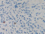 DAB staining on IHC-P; Sample: Human Stomach cancer Tissue; Primary Ab: 30ug/ml Mouse Anti-Human RETN Antibody Second Ab: 2ug/mL HRP-Linked Caprine Anti-Mouse IgG Polyclonal Antibody