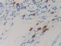 DAB staining on IHC-P; Sample: Human Colorectal cancer Tissue; Primary Ab: 30ug/ml Mouse Anti-Human RETN Antibody; Second Ab: 2ug/mL HRP-Linked Caprine Anti-Mouse IgG Polyclonal Antibody