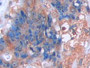DAB staining on IHC-P; Sample: Human Colorectal cancer Tissue; Primary Ab: 40ug/ml Mouse Anti-Human CCK8 Antibody Second Ab: 2ug/mL HRP-Linked Caprine Anti-Mouse IgG Polyclonal Antibody