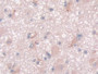 DAB staining on IHC-P; Sample: Human Glioma Tissue; Primary Ab: 20ug/ml Mouse Anti-Human NTXI Antibody Second Ab: 2ug/mL HRP-Linked Caprine Anti-Mouse IgG Polyclonal Antibody