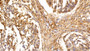 DAB staining on IHC-P; Sample: Human Ovarian cancer Tissue; Primary Ab: 10ug/ml Rabbit Anti-Human P53 Antibody; Second Ab: 2ug/mL HRP-Linked Caprine Anti-Rabbit IgG Polyclonal Antibody