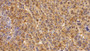 DAB staining on IHC-P; Sample: Human Liver cancer Tissue; Primary Ab: 10ug/ml Rabbit Anti-Human P53 Antibody; Second Ab: 2ug/mL HRP-Linked Caprine Anti-Rabbit IgG Polyclonal Antibody
