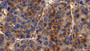 DAB staining on IHC-P; Sample: Human Liver cancer Tissue; Primary Ab: 10ug/ml Rabbit Anti-Human CAT Antibody; Second Ab: 2ug/mL HRP-Linked Caprine Anti-Rabbit IgG Polyclonal Antibody