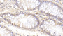 DAB staining on IHC-P; Sample: Human Colon Tissue; Primary Ab: 20ug/ml Mouse Anti-Human MMP7 Antibody; Second Ab: 2ug/mL HRP-Linked Caprine Anti-Mouse IgG Polyclonal Antibody