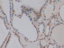 DAB staining on IHC-P; Sample: Human Thyroid Tissue; Primary Ab: 10ug/ml Mouse Anti-Human GATA3 Antibody Second Ab: 2ug/mL HRP-Linked Caprine Anti-Mouse IgG Polyclonal Antibody