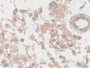 DAB staining on IHC-P; Sample: Human Glioma Tissue; Primary Ab: 30ug/ml Mouse Anti-Human NSE Antibody Second Ab: 2ug/mL HRP-Linked Caprine Anti-Mouse IgG Polyclonal Antibody