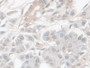 DAB staining on IHC-P; Sample: Human Pancreatic cancer Tissue; Primary Ab: 30ug/ml Mouse Anti-Human NSE Antibody; Second Ab: 2ug/mL HRP-Linked Caprine Anti-Mouse IgG Polyclonal Antibody