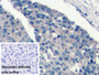 DAB staining on IHC-P; Sample: Human Liver cancer Tissue; Primary Ab: 10ug/ml Mouse Anti-Human VEGF165 Antibody; Control: Used PBS instead of primary antibody; Second Ab: 2ug/ml HRP-Linked Caprine Anti-Mouse IgG Polyclonal Antibody