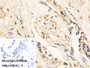 DAB staining on IHC-P; Sample: Human Breast cancer Tissue Primary Ab: 20ug/ml Mouse Anti-Human GAPDH Antibody Control: Used PBS instead of primary antibody Second Ab: 2ug/ml HRP-Linked Caprine Anti-Mouse IgG Polyclonal Antibody