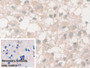 DAB staining on IHC-P; Sample: Human Glioma Tissue; Primary Ab: 30ug/ml Mouse Anti-Human NSE Antibody; Control: Used PBS instead of primary antibody; Second Ab: 2ug/ml HRP-Linked Caprine Anti-Mouse IgG Polyclonal Antibody