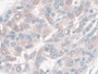 DAB staining on IHC-P; Sample: Human Liver cancer Tissue; Primary Ab: 30ug/ml Mouse Anti-Human Hpt Antibody; Second Ab: 2ug/mL HRP-Linked Caprine Anti-Mouse IgG Polyclonal Antibody
