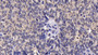 DAB staining on IHC-P; Sample: Human Ovarian cancer Tissue; Primary Ab: 20ug/ml Rabbit Anti-Multi-species CT Antibody Second Ab: 2ug/mL HRP-Linked Caprine Anti-Rabbit IgG Polyclonal Antibody