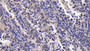 DAB staining on IHC-P; Sample: Human Endometrial cancer Tissue; Primary Ab: 20ug/ml Rabbit Anti-Multi-species CT Antibody; Second Ab: 2ug/mL HRP-Linked Caprine Anti-Rabbit IgG Polyclonal Antibody