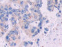 DAB staining on IHC-P; Sample: Human Breast cancer Tissue; Primary Ab: 30ug/ml Mouse Anti-Human IDH1 Antibody Second Ab: 2ug/mL HRP-Linked Caprine Anti-Mouse IgG Polyclonal Antibody