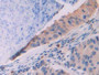 DAB staining on IHC-P; Sample: Human Lung cancer Tissue; Primary Ab: 30ug/ml Mouse Anti-Human IDH1 Antibody; Second Ab: 2ug/mL HRP-Linked Caprine Anti-Mouse IgG Polyclonal Antibody