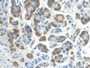DAB staining on IHC-P; Sample: Human Pancreatic cancer Tissue; Primary Ab: 20ug/ml Mouse Anti-Human REG3g Antibody Second Ab: 2ug/mL HRP-Linked Caprine Anti-Mouse IgG Polyclonal Antibody