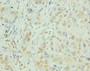 Immunohistochemistry of paraffin-embedded human liver cancer using CAC07046 at dilution of 1:100