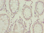 Immunohistochemistry of paraffin-embedded human colon cancer using CAC07068 at dilution of 1:100