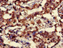 Immunohistochemistry of paraffin-embedded human gastric cancer using CAC07075 at dilution of 1:100