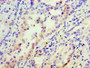 Immunohistochemistry of paraffin-embedded human lung cancer using CAC07191 at dilution of 1:100