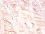 Immunohistochemistry of paraffin-embedded human colon cancer using CAC07327 at dilution of 1:100