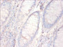 Immunohistochemistry of paraffin-embedded human colon cancer using CAC07448 at dilution of 1:50