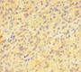 Immunohistochemistry of paraffin-embedded human glioma using CAC07686 at dilution of 1:100