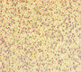 Immunohistochemistry of paraffin-embedded human glioma using CAC07689 at dilution of 1:100