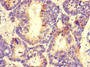 Immunohistochemistry of paraffin-embedded human colon cancer using CAC07702 at dilution of 1:100