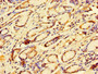 Immunohistochemistry of paraffin-embedded human gastric cancer using CAC07733 at dilution of 1:100