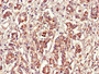 Immunohistochemistry of paraffin-embedded human pancreatic cancer using CAC07737 at dilution of 1:100