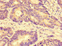 Immunohistochemistry of paraffin-embedded human colon cancer using CAC07750 at dilution of 1:100