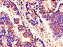 Immunohistochemistry of paraffin-embedded human colon cancer using CAC07934 at dilution of 1:100