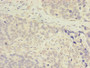 Immunohistochemistry of paraffin-embedded human gastric cancer using CAC08209 at dilution of 1:100
