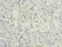Immunohistochemistry of paraffin-embedded human gastric cancer using CAC08213 at dilution of 1:100