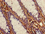 Immunohistochemistry of paraffin-embedded human colon cancer using CAC08250 at dilution of 1:100