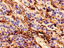 Immunohistochemistry analysis of human bladder cancer using CAC08257 at dilution of 1:100