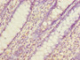 Immunohistochemistry of paraffin-embedded human colon cancer using CAC08272 at dilution of 1:100