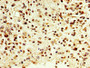 IHC image diluted at 1:500 and staining in paraffin-embedded human glioma cancer performed on a Leica BondTM system. After dewaxing and hydration, antigen retrieval was mediated by high pressure in a citrate buffer (pH 6.0). Section was blocked with 10% normal goat serum 30min at RT. Then primary antibody (1% BSA) was incubated at 4°C overnight. The primary is detected by a biotinylated secondary antibody and visualized using an HRP conjugated SP system.