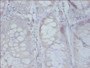 Immunohistochemistry of paraffin-embedded human colon cancer using CAC08354 at dilution of 1: 50