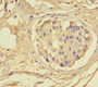 Immunohistochemistry of paraffin-embedded human breast cancer using CAC08358 at dilution of 1:100